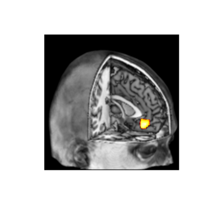 Superimposed functional image to show a brain area, medial obitofrontal cortex (mOFC)